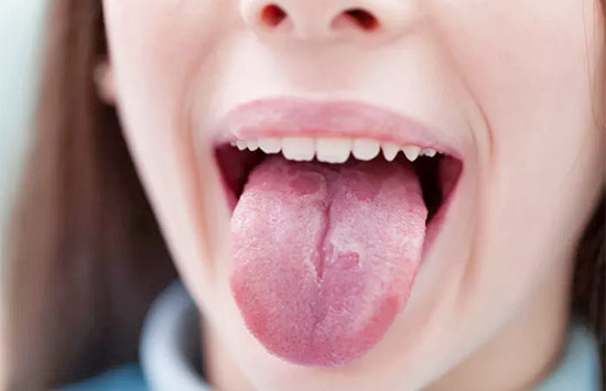 Mouthwash burn my tongue